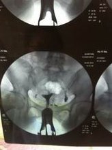 女性子宫肌瘤在海口玛丽医院做三代试管预算八万块够不够？